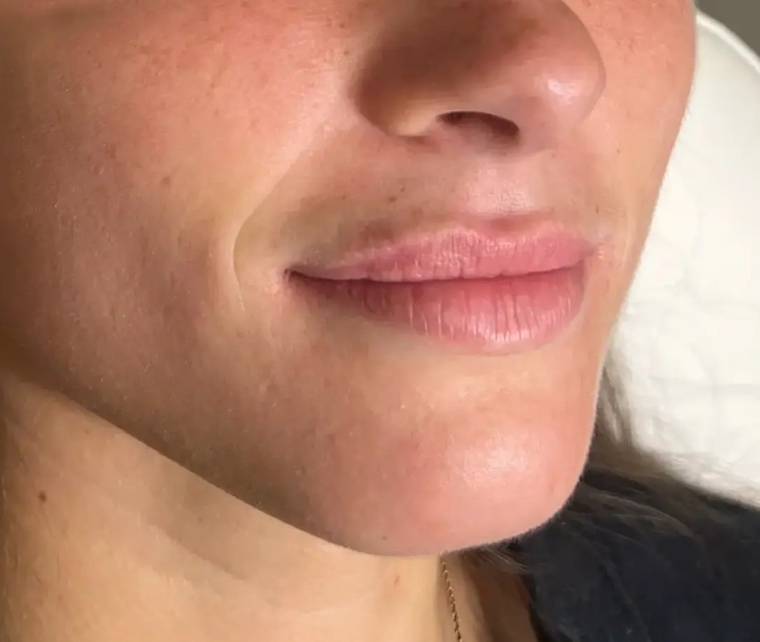 Dermal Fillers Before (1)